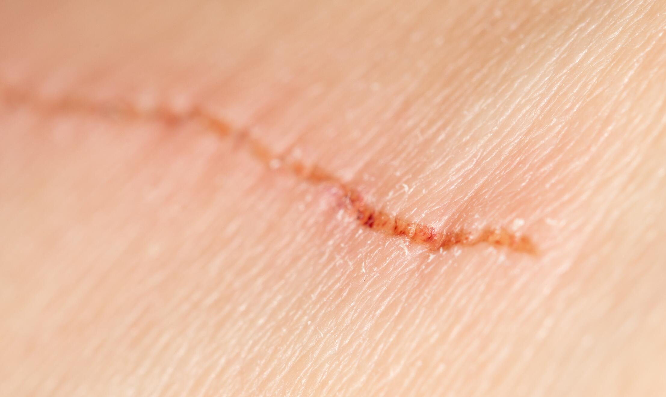 teken infectie litteken